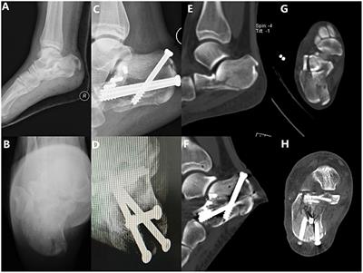 Percutaneous Cannulated Screw Fixation vs. Plating With Minimally Invasive Longitudinal Approach After Closed Reduction for Intra-Articular Tongue-Type Calcaneal Fractures: A Retrospective Cohort Study